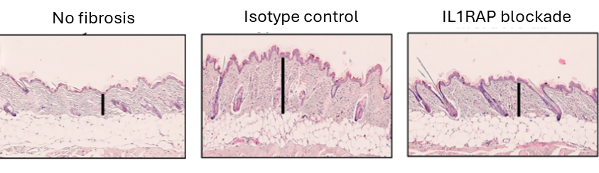 IL1RAP-blockad minskar fibros